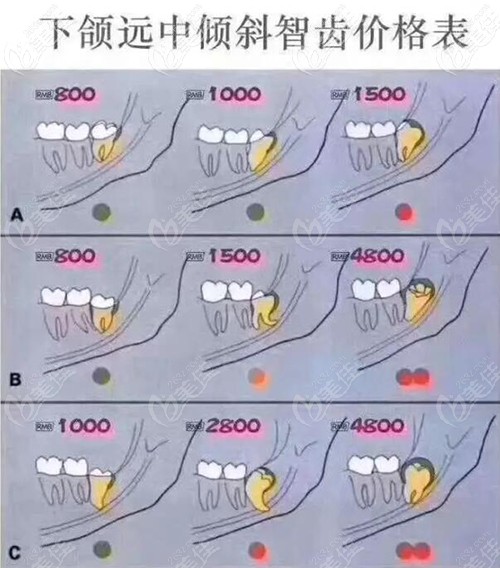 下頜遠(yuǎn)中傾斜阻生智齒價(jià)格表