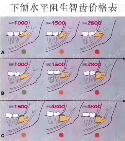 下頜水平阻生智齒價(jià)格表