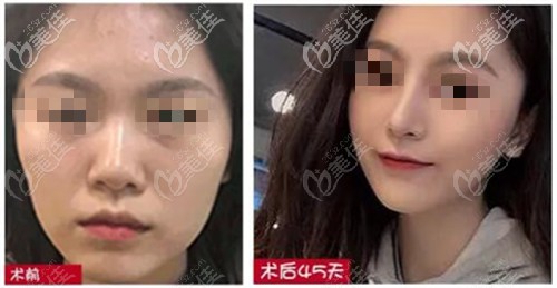 王德寧隆鼻案例