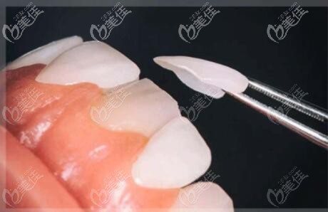 牙齒美白做全瓷貼面對自己的牙齒傷害大不大 牙齒美白做全瓷貼面對自己的牙齒傷害大不大