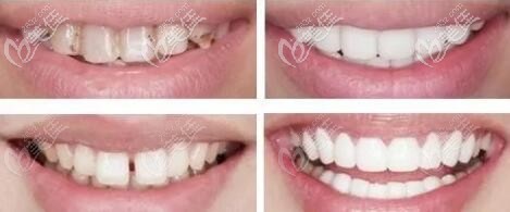 牙齒瓷貼面美白前后對比照 牙齒瓷貼面美白前后對比照