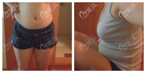做腰腹吸脂前的腰圍 做腰腹吸脂前的腰圍