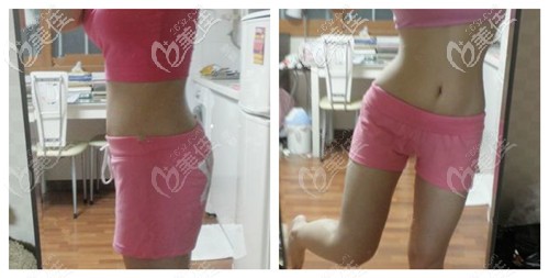 現(xiàn)在回頭看看我到駐馬店締萊美做肚子吸脂前的照片，簡直不忍直視！