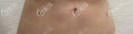 腰腹吸脂后的針眼大小 腰腹吸脂后的針眼大小