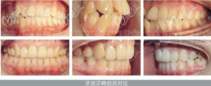 牙齒擁擠、前突、拔除4顆前磨牙后，在南京美奧戴上國產(chǎn)的正雅矯治器進行正畸