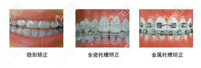 常用的牙齒矯正器