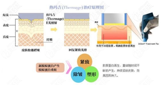 熱瑪吉治療的原理圖