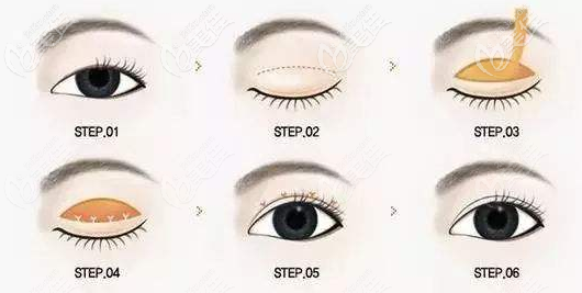 全切雙眼皮流程 全切雙眼皮流程