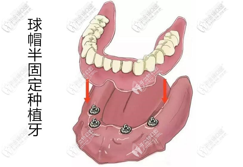 全口半固定種植牙 全口半固定種植牙