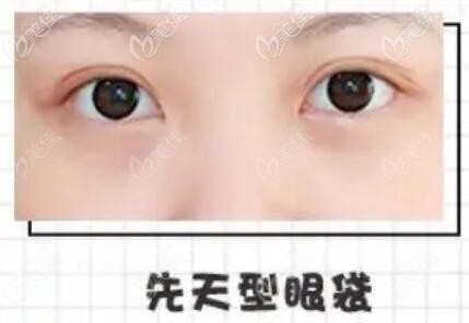 先天性眼袋怎么治療的方法有哪些