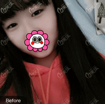 我做埋線(xiàn)雙眼皮手術(shù)前 我做埋線(xiàn)雙眼皮手術(shù)前