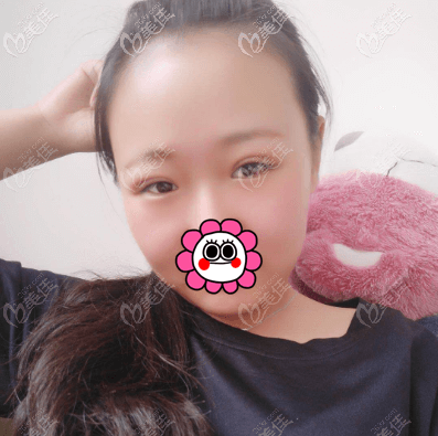 季一發(fā)給我做的埋線(xiàn)雙眼皮沒(méi)有出現(xiàn)眼皮一直發(fā)黑的情況 季一發(fā)給我做的埋線(xiàn)雙眼皮沒(méi)有出現(xiàn)眼皮一直發(fā)黑的情況