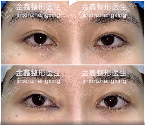 金鑫內(nèi)眼角修復(fù)回包案例