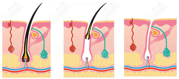 冰點(diǎn)脫唇毛原理示意圖