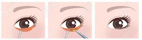內(nèi)切去眼袋過程