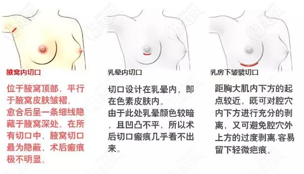 假體隆胸的常見切口