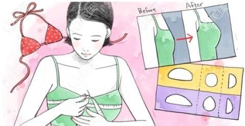 假體隆胸是幾級疼痛