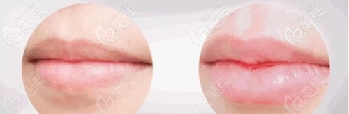 廈門臉博士喬雅登玻尿酸豐唇案例