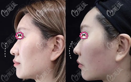 廈門臉博士喬雅登玻尿酸注射蘋果肌