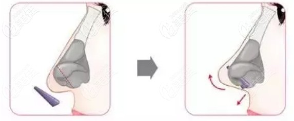 箭頭鼻的矯正方法 箭頭鼻的矯正方法