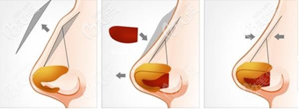 鷹鉤鼻矯正過程 鷹鉤鼻矯正過程