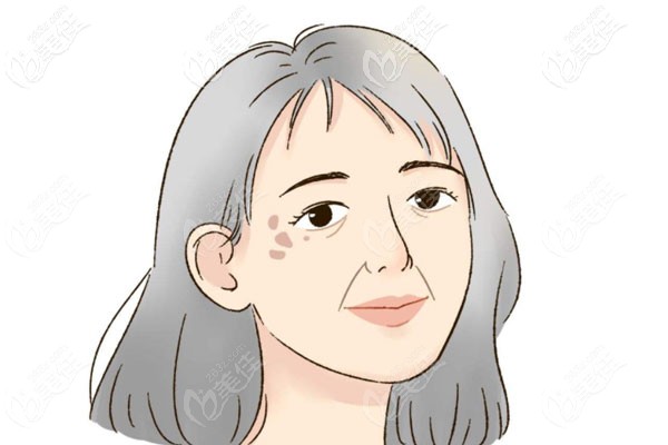 褐青斑和黃褐斑哪個更難去除