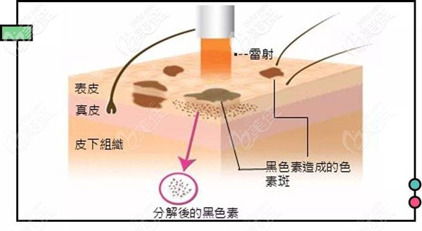超皮秒激光祛斑