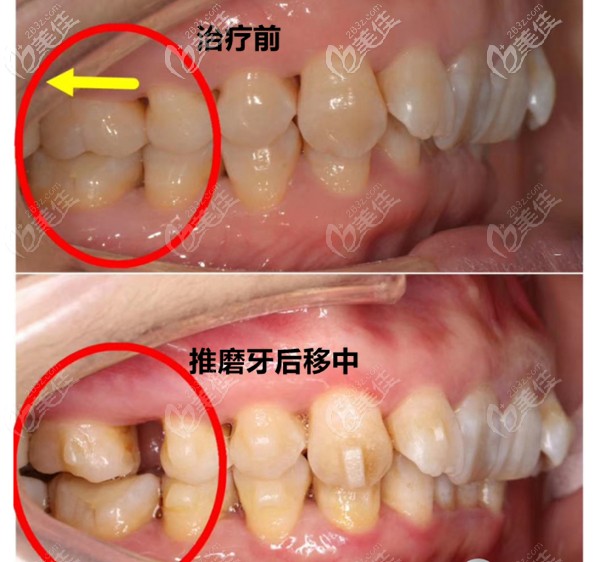 推磨牙后移的前后對(duì)比圖 推磨牙后移的前后對(duì)比圖