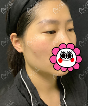 做定點雙眼皮前 做定點雙眼皮前