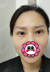 我做定點雙眼皮有20多天了 我做定點雙眼皮有20多天了