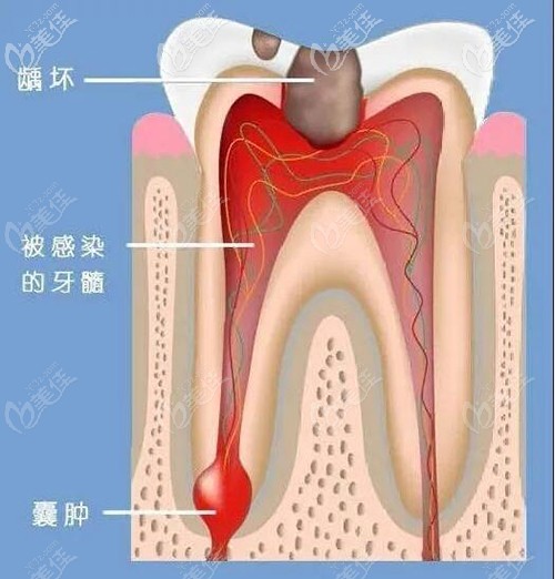 需要做根管治療的情況