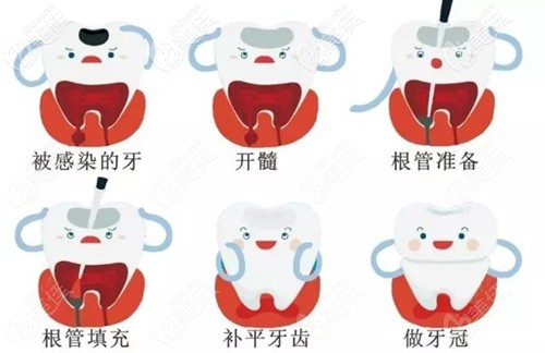 根管治療的過程