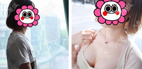 昆明吳氏嘉美脂肪豐胸案例