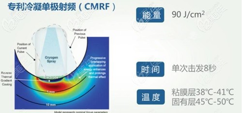 美國薇蜜viveve縮陰的原理