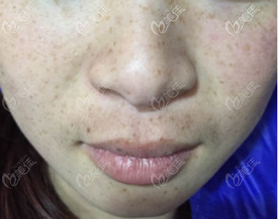 術(shù)前 術(shù)前