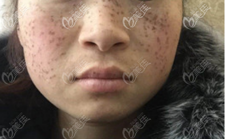C6祛斑結(jié)痂后的樣子 C6祛斑結(jié)痂后的樣子