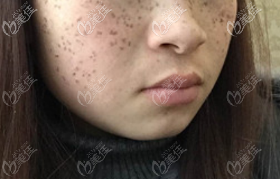 C6祛斑第10天的樣子 C6祛斑第10天的樣子