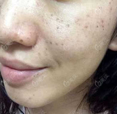 色素沉著加上反黑的樣子 色素沉著加上反黑的樣子