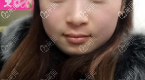 同時(shí)做過(guò)C6和皮秒祛斑的我，揭秘哪個(gè)效果好！