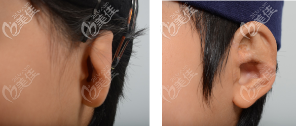 貼發(fā)耳矯正<span style= 貼發(fā)耳矯正<span style=