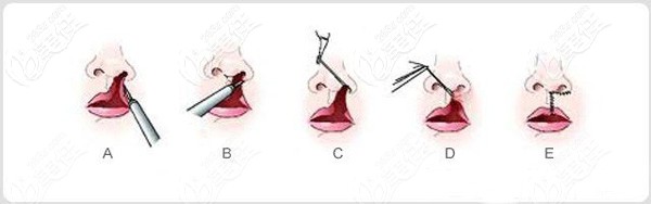 巫國(guó)輝做唇裂修復(fù)的原理
