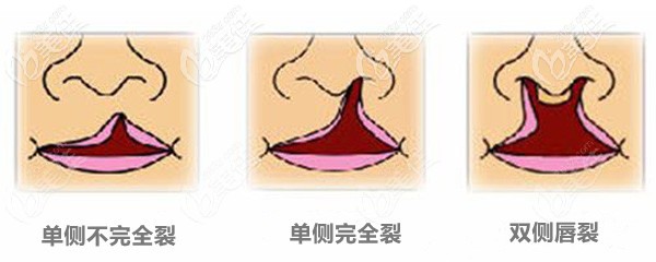 不同情況唇裂怎么修復(fù)呢