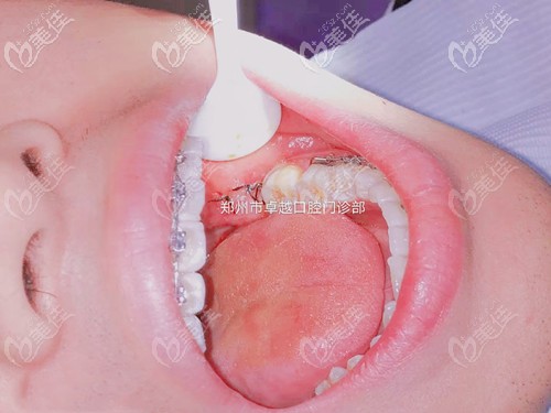 驚喜,在鄭州這家牙科拔阻生智齒的價格便宜體驗感還比較好