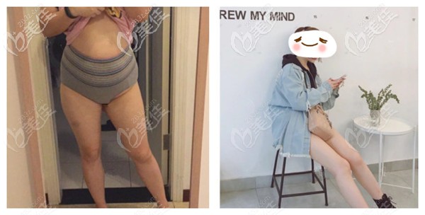 壹美天成整形大腿抽脂案例