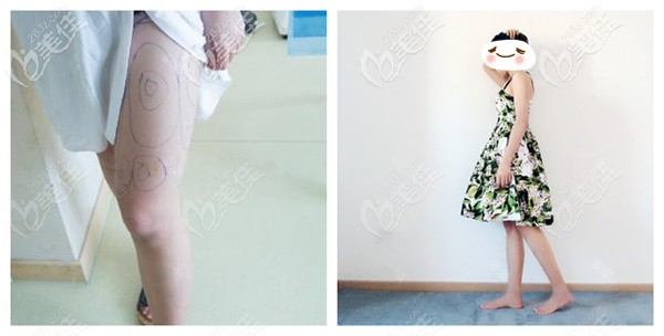 姜留剛醫(yī)生做大腿抽脂效果對(duì)比圖