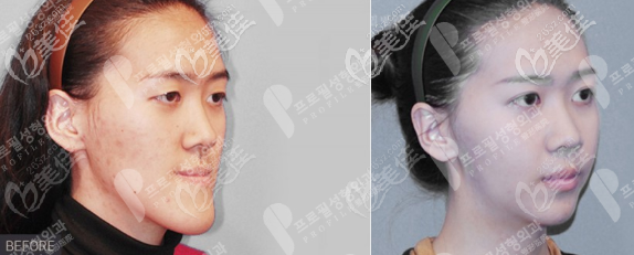 韓國(guó)普羅菲耳做輪廓手術(shù)挺好的