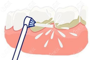 北京佳美口腔永定路店洗牙價(jià)格多少 北京佳美口腔永定路店洗牙價(jià)格多少