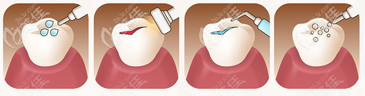 超聲波洗牙示意圖 超聲波洗牙示意圖