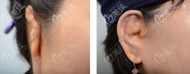 韓國(guó)普羅菲耳貼發(fā)耳矯正真人圖