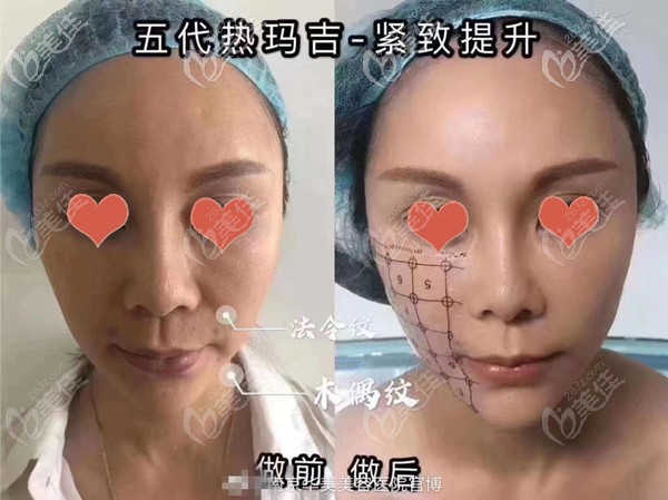 四代五代熱瑪吉都有的南京華美，看過熱瑪吉對比效果圖，才做的全面部600發(fā)抗衰